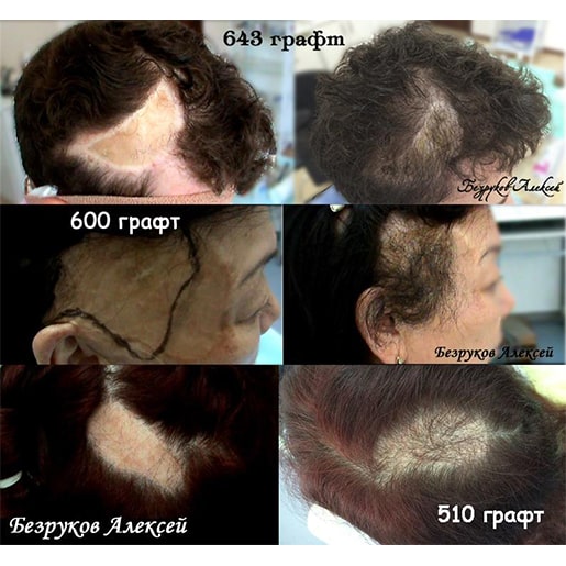 Трансплантация волос