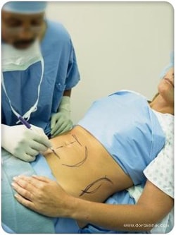 abdominoplastika-1