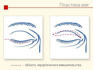 blefaroplastika-3